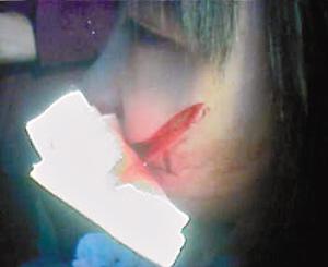 17岁高二女生惨遭同学割脸 公务员参与斗殴