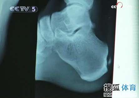 (资料图)刘翔右脚跟腱的x光片,右侧白色小颗粒为病患之处.