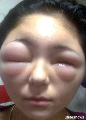 少女使用染发剂过敏头部肿胀眼皮外凸(组图)