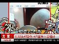 文章拍戏头部受伤滴血水 长5厘米入院缝针