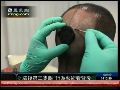 美国艺术家在后脑安装摄像头作为第三只眼