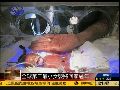 女婴出生时体重仅270克 是全球第3小婴儿