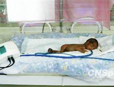重庆儿童医院救活中国西南最轻“袖珍宝宝”