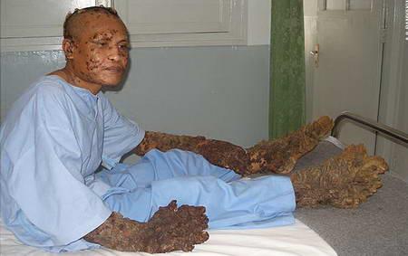 印尼树人手术图片