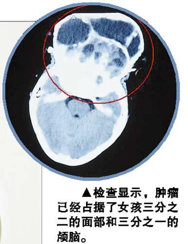 由於患有顱腦頜面腫瘤,22歲的吳小燕面部嚴重畸形,側臉有點像