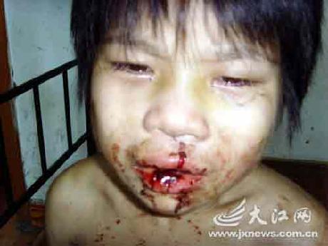 脚肿得变形本报抚州讯记者舒晓燕摄影报道:满脸满身的血迹,嘴巴被打得