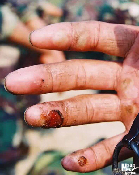 军人手受伤真实照片图片